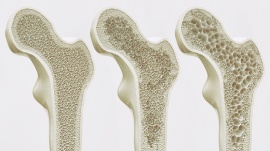 The 3 M's for Bone Health